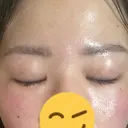 上まぶたの脂肪取り 9BeautyClinic DAY 16 サムネイル用