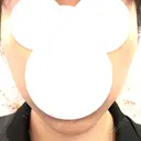 糸リフト 福岡TAクリニック AFTER サムネイル用