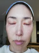 ピーリング（ハリ・ツヤ） まゆりなclinic 名古屋栄 AFTER サムネイル用