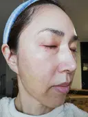 ピーリング（ハリ・ツヤ） まゆりなclinic 名古屋栄 DAY 3 サムネイル用