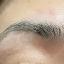 医療脱毛（顔） Jスキンクリニック 【J-SKIN clinic】 DAY 1 サムネイル用