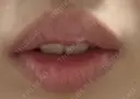 ヒアルロン酸注入（唇） 橿原 BEAUTY CLINIC AFTER サムネイル用
