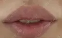 ヒアルロン酸注入（唇） 橿原 BEAUTY CLINIC DAY 23 サムネイル用