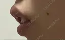 ヒアルロン酸注入（唇） 橿原 BEAUTY CLINIC DAY 23 サムネイル用