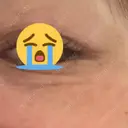 ボトックス（目尻） TCB東京中央美容外科 高崎院 AFTER サムネイル用