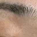 医療脱毛（顔） Jスキンクリニック 【J-SKIN clinic】 AFTER サムネイル用