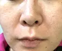 ヴェルヴェットスキン 聖心美容クリニック 広島院 AFTER サムネイル用