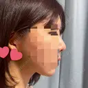 脂肪注入（額） GRACIA clinic 【グラシアクリニック】 DAY 32 サムネイル用