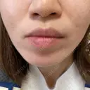 ダーマペン 若倉診療所 DAY 6 サムネイル用