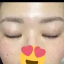 上まぶたの脂肪取り 9BeautyClinic DAY 18 サムネイル用