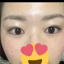上まぶたの脂肪取り 9BeautyClinic DAY 18 サムネイル用