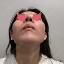 隆鼻術 / 鼻中隔延長（切開） / 鼻翼基部形成（貴族手術） ヴェリテクリニック 銀座院 DAY 43 サムネイル用