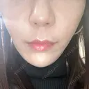 糸リフト / 脂肪吸引（顔） / ボトックス（エラ・小顔） / ヒアルロン酸注入（頬） Tokyo Tensei Clinic 新宿院 DAY 20 サムネイル用