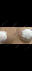 乳頭縮小 お茶の水美容形成クリニック AFTER サムネイル用