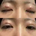 二重埋没 / ハイフ（顔） 日本ウェルネス再生クリニック DAY 0 サムネイル用