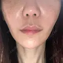 糸リフト / 脂肪吸引（顔） / ボトックス（エラ・小顔） / ヒアルロン酸注入（頬） Tokyo Tensei Clinic 新宿院 DAY 21 サムネイル用