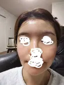 ヒアルロン酸注入（額） / ヒアルロン酸注入（こめかみ） LA CLEF CLINIC（ラクレクリニック） DAY 8 サムネイル用