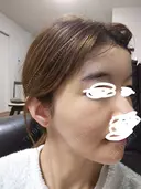 ヒアルロン酸注入（額） / ヒアルロン酸注入（こめかみ） LA CLEF CLINIC（ラクレクリニック） DAY 8 サムネイル用