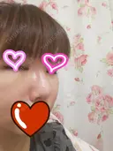 切開リフト こうべ花時計クリニック DAY 14 サムネイル用