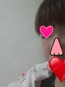 切開リフト こうべ花時計クリニック DAY 14 サムネイル用