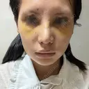 鼻尖形成（切開） / 小鼻縮小（切開） / ほくろ・いぼ切除（肌） / 軟骨移植 / 骨切幅寄せ / 鼻尖形成（非切開） 銀座マイアミ美容外科 DAY 8 サムネイル用