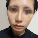 鼻尖形成（切開） / 小鼻縮小（切開） / ほくろ・いぼ切除（肌） / 軟骨移植 / 骨切幅寄せ / 鼻尖形成（非切開） 銀座マイアミ美容外科 DAY 10 サムネイル用