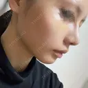 鼻尖形成（切開） / 小鼻縮小（切開） / ほくろ・いぼ切除（肌） / 軟骨移植 / 骨切幅寄せ / 鼻尖形成（非切開） 銀座マイアミ美容外科 DAY 10 サムネイル用