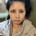鼻尖形成（切開） / 小鼻縮小（切開） / ほくろ・いぼ切除（肌） / 軟骨移植 / 骨切幅寄せ / 鼻尖形成（非切開） 銀座マイアミ美容外科 DAY 15 サムネイル用