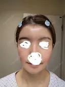 ヒアルロン酸注入（額） / ヒアルロン酸注入（こめかみ） LA CLEF CLINIC（ラクレクリニック） DAY 9 サムネイル用