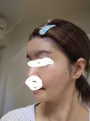 ヒアルロン酸注入（額） / ヒアルロン酸注入（こめかみ） LA CLEF CLINIC（ラクレクリニック） DAY 9 サムネイル用