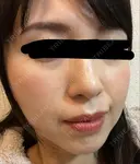 イオン導入 椿クリニック 名古屋院 DAY 5 サムネイル用