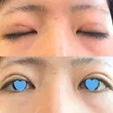 二重埋没 / ハイフ（顔） 日本ウェルネス再生クリニック AFTER サムネイル用