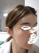 ヒアルロン酸注入（額） / ヒアルロン酸注入（こめかみ） LA CLEF CLINIC（ラクレクリニック） DAY 10 サムネイル用