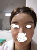 ヒアルロン酸注入（額） / ヒアルロン酸注入（こめかみ） LA CLEF CLINIC（ラクレクリニック） AFTER サムネイル用