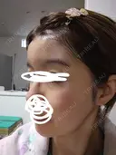 ヒアルロン酸注入（額） / ヒアルロン酸注入（こめかみ） LA CLEF CLINIC（ラクレクリニック） DAY 10 サムネイル用