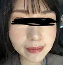 イオン導入 椿クリニック 名古屋院 DAY 7 サムネイル用