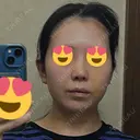 鼻尖形成（切開） / 小鼻縮小（切開） / 脂肪吸引（顔） / 軟骨移植 / 骨切幅寄せ / 鼻尖縮小 / 鼻柱挙上 銀座マイアミ美容外科 DAY 8 サムネイル用