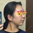 鼻尖形成（切開） / 小鼻縮小（切開） / 脂肪吸引（顔） / 軟骨移植 / 骨切幅寄せ / 鼻尖縮小 / 鼻柱挙上 銀座マイアミ美容外科 DAY 8 サムネイル用