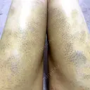 脂肪吸引（脚） / 豊胸（脂肪注入） S.T styleクリニック DAY 5 サムネイル用