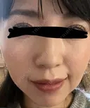 イオン導入 椿クリニック 名古屋院 DAY 9 サムネイル用