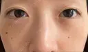 下まぶたたるみ取り / 下まぶたの脂肪取り 湘南美容クリニック 京都院 DAY 5 サムネイル用