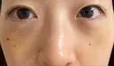 下まぶたたるみ取り / 下まぶたの脂肪取り 湘南美容クリニック 京都院 DAY 4 サムネイル用