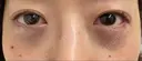 下まぶたたるみ取り / 下まぶたの脂肪取り 湘南美容クリニック 京都院 DAY 0 サムネイル用