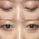 下まぶたの脂肪取り Brandnew Beauty Clinic DAY 14 サムネイル用