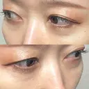 下まぶたの脂肪取り Brandnew Beauty Clinic DAY 14 サムネイル用