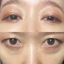 下まぶたの脂肪取り Brandnew Beauty Clinic DAY 14 サムネイル用