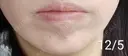 ボトックス（あご） 湘南美容クリニック 宇都宮院 DAY 10 サムネイル用