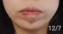 ボトックス（あご） 湘南美容クリニック 宇都宮院 DAY 12 サムネイル用