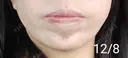 ボトックス（あご） 湘南美容クリニック 宇都宮院 DAY 13 サムネイル用