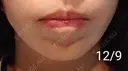 ボトックス（あご） 湘南美容クリニック 宇都宮院 DAY 14 サムネイル用